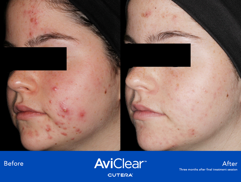 AviClear Before and After